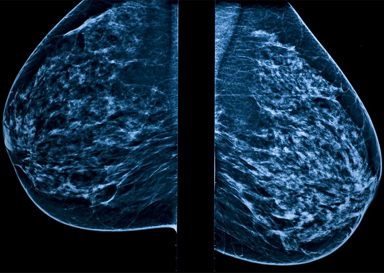 Mammogram