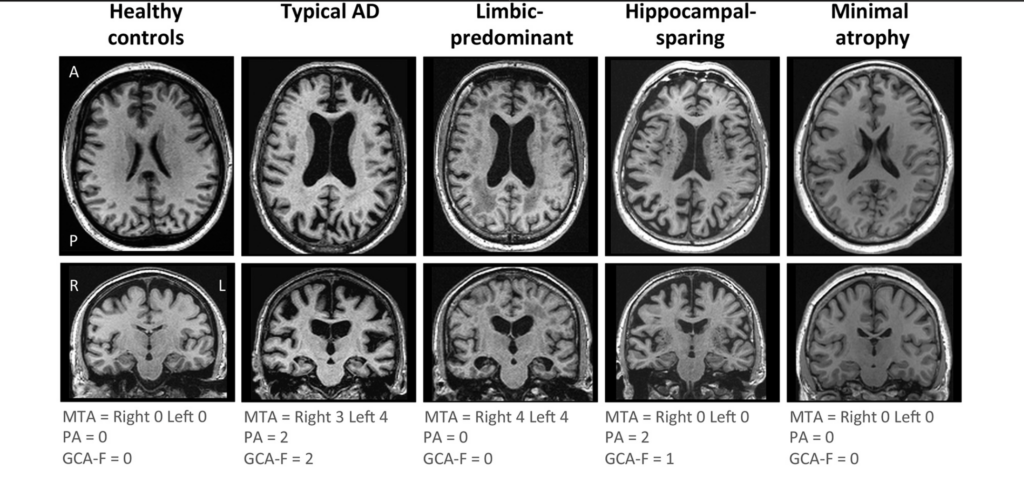 When Dementia Has a Seat at the Table